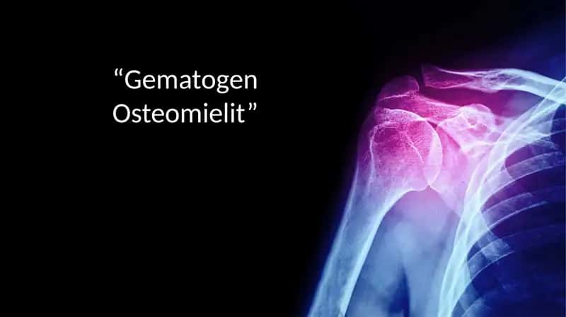 Gematogen osteomiyelit mustaqil ish . tibbiyot