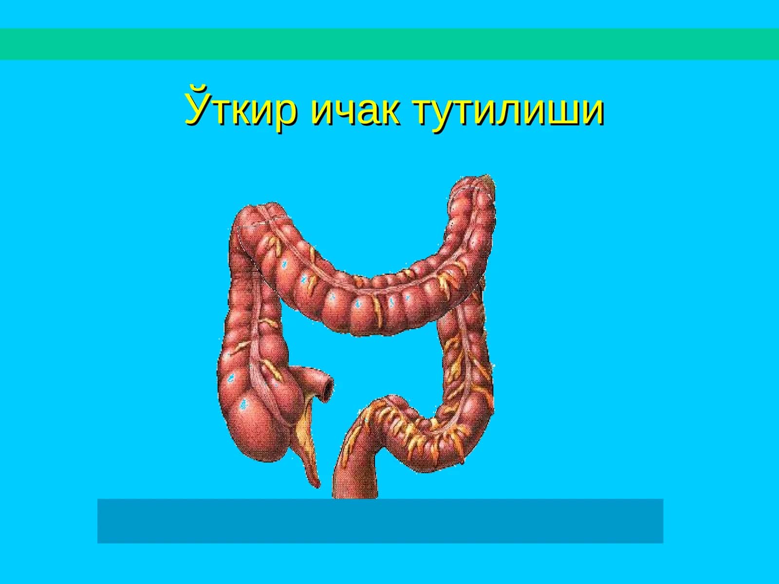 Ўткир ичак тутилиши