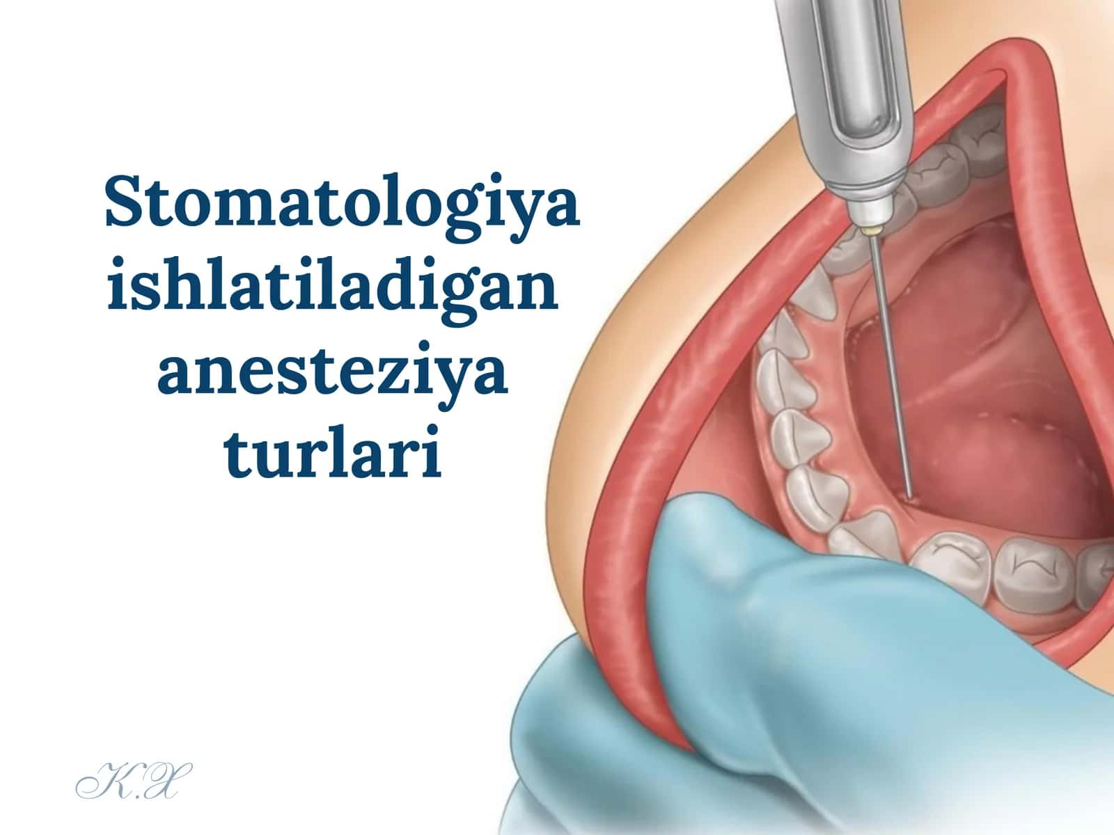 Stomatologiyada ishlatiladigan anesteziya turlari