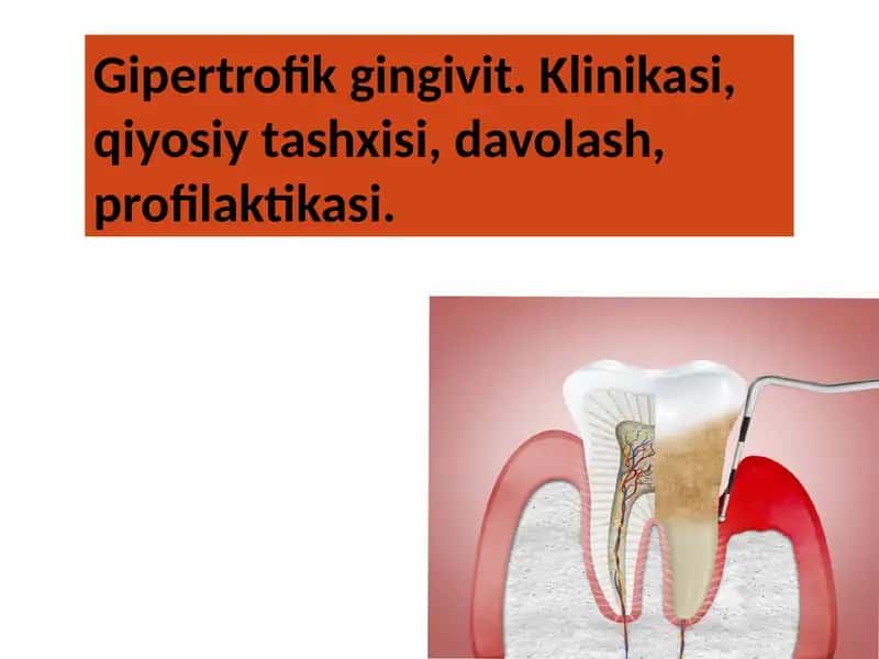Gipertrofik gingivit