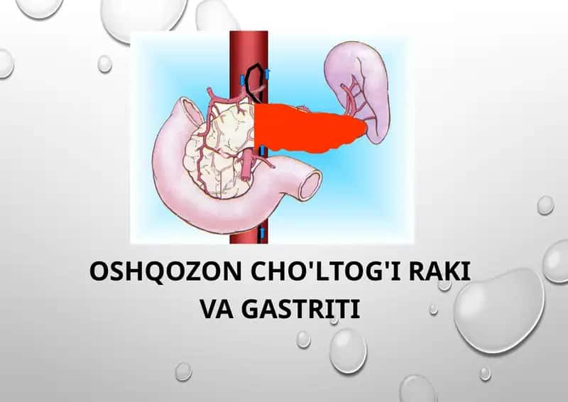 Oshqozonsaratoni