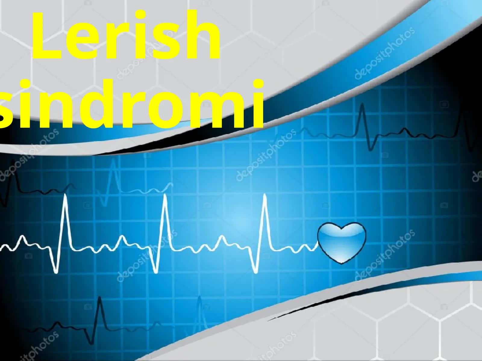 Lerishsindromi