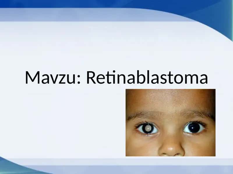 Retinablastomalar