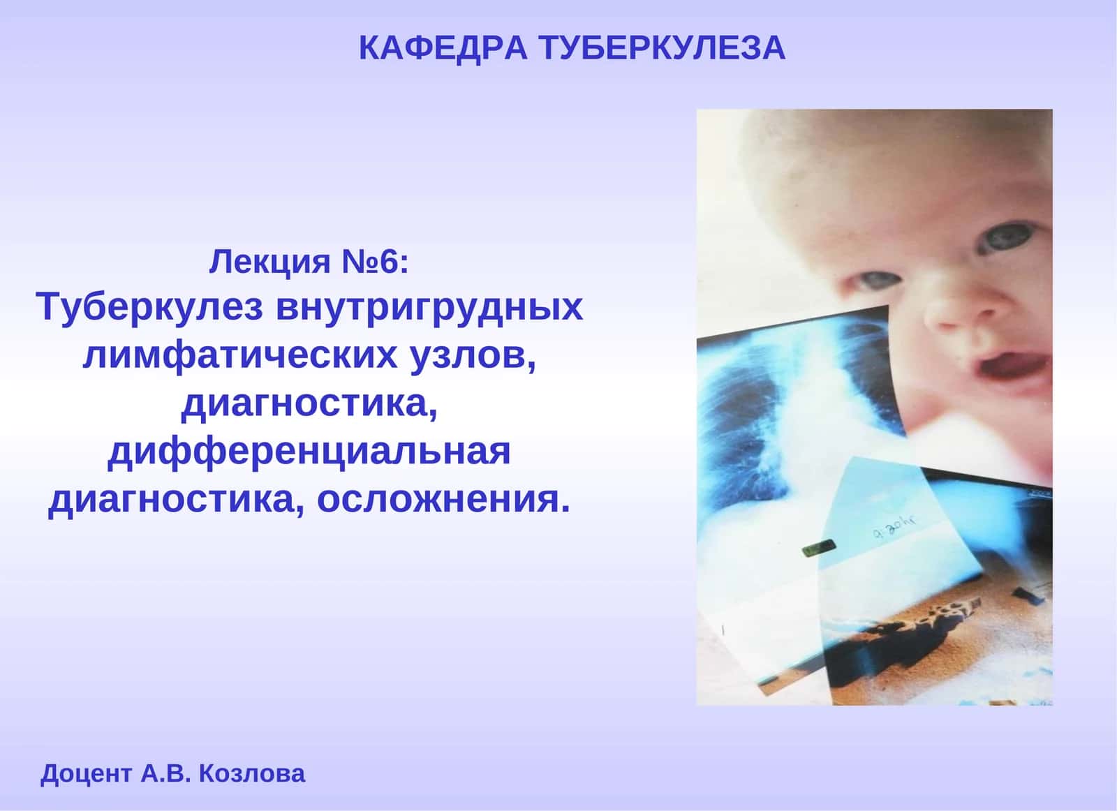 Туберкулез внутригрудных лимфатических узлов