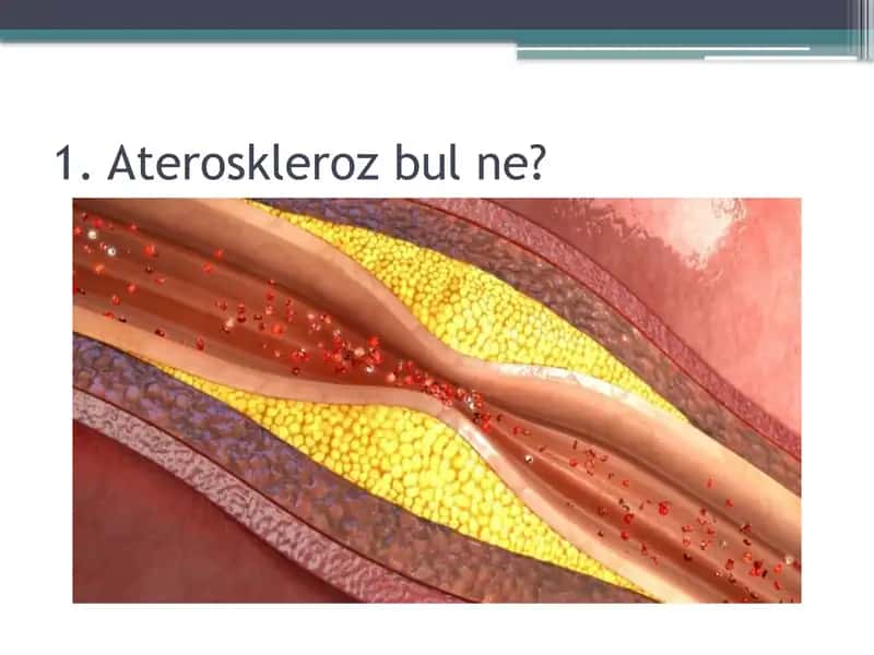 Ateroskleroz