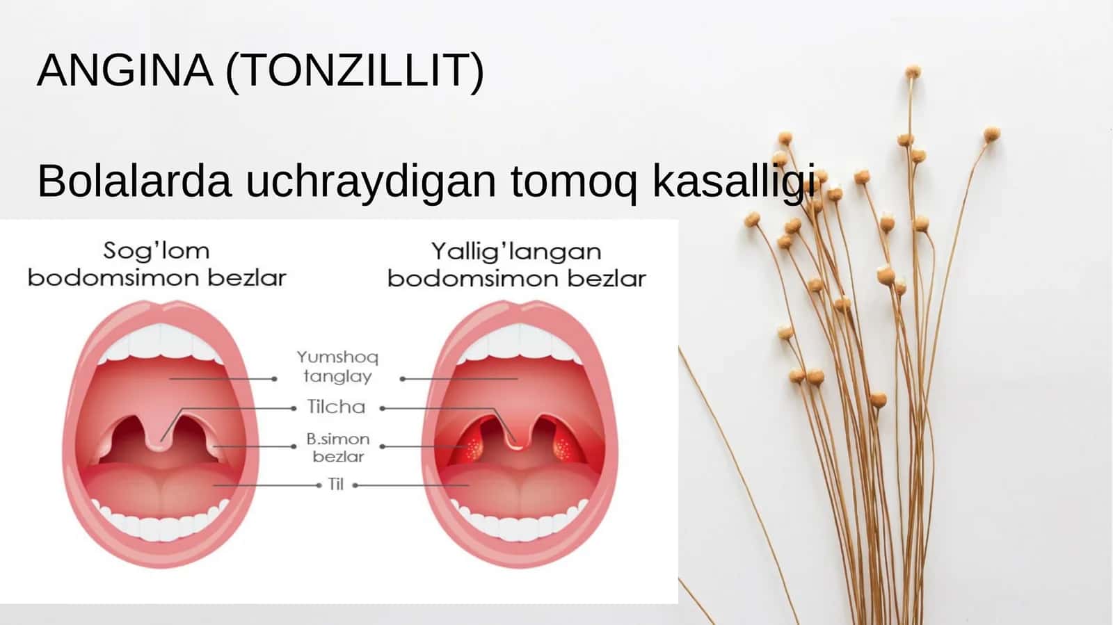 Angina(Tonzillit)