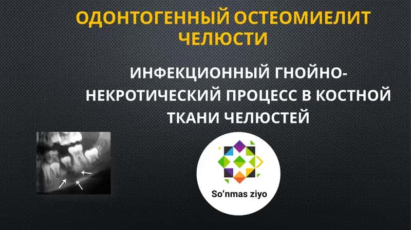 Одонтогенный остеомиелит челюсти