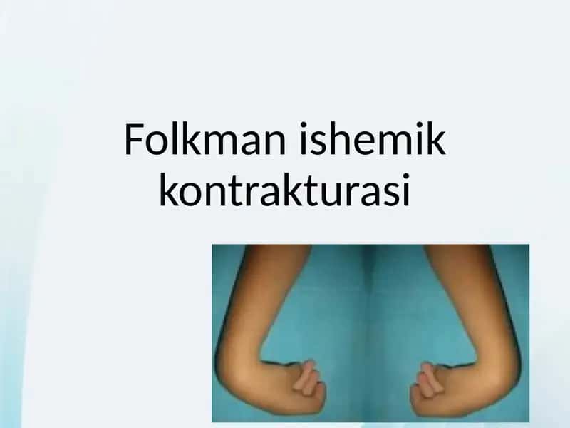 Folkman ishemik kontrakturasi