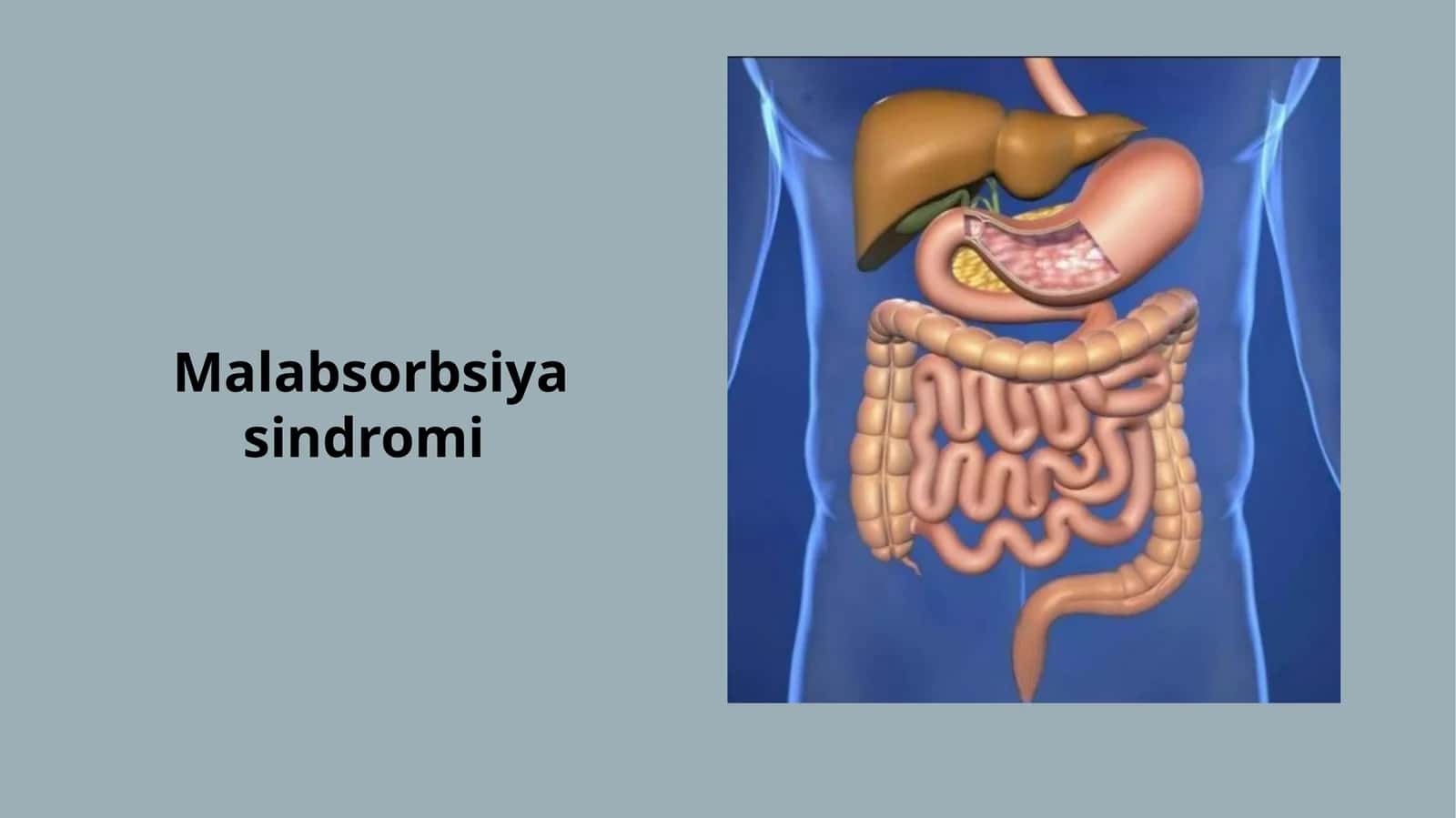 Malabsorbsiya sindromi — 30 slaydli taqdimot | Nelson Pediatrics