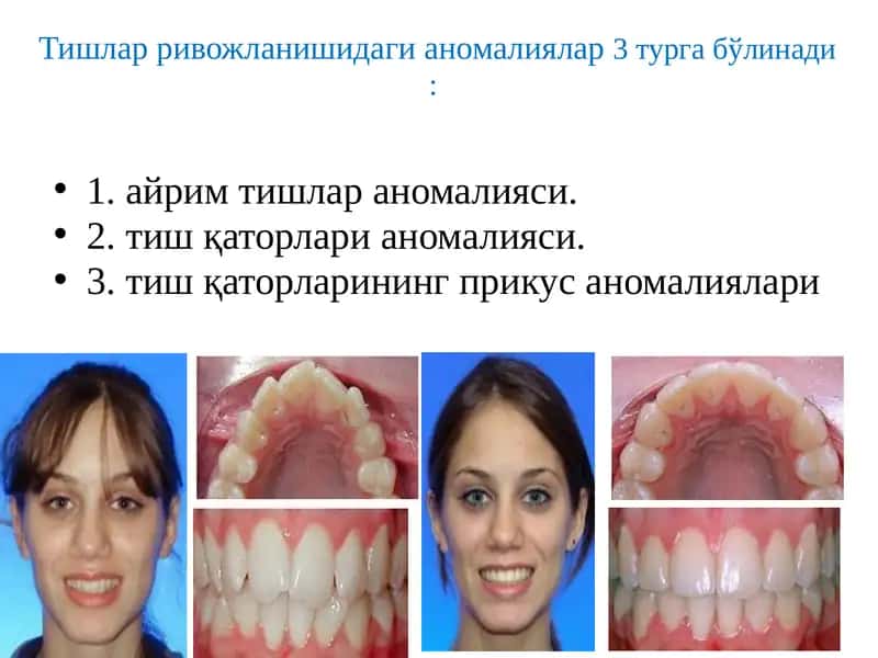 Тишлардаги аномалиялар