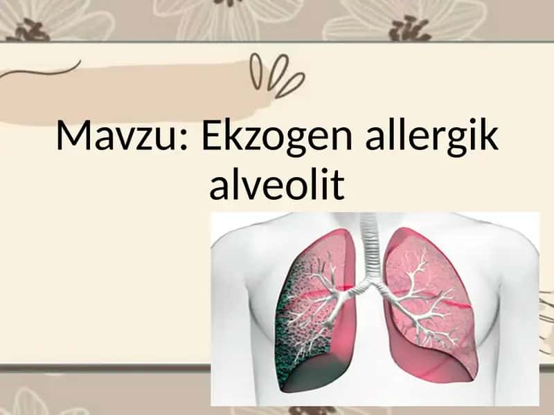 Ekzogen allergik alveolit