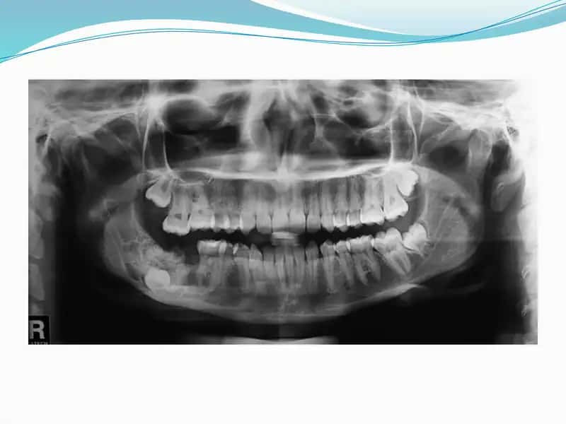 Specialized treatment for tooth extraction and surgery