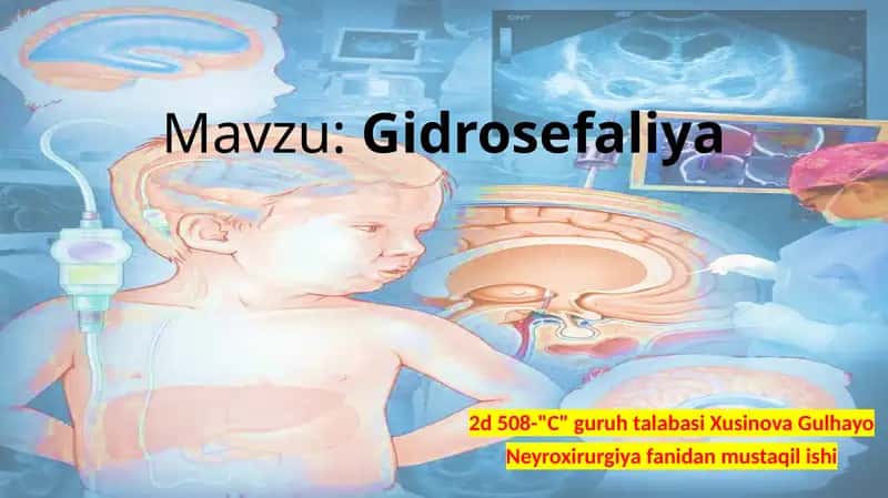 Gidrosefaliya