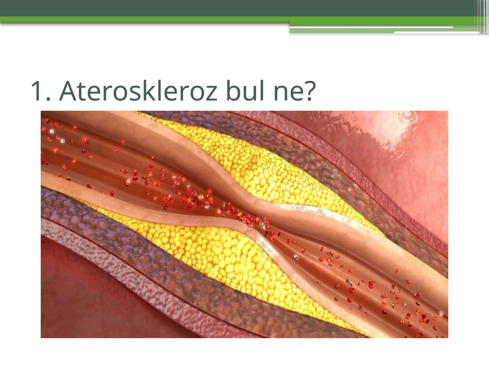 Ateroskleroz