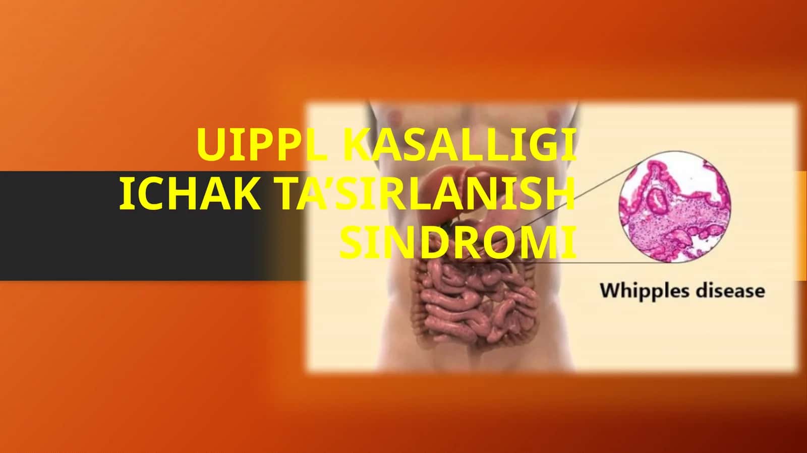 Uippl kasalligi va Ichak ta’sirlanish sindromi (ITS): etiologiya, diagnostika va davolash