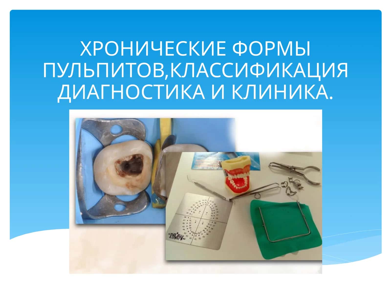 ХРОНИЧЕСКИЕ ФОРМЫ ПУЛЬПИТОВ,КЛАССИФИКАЦИЯ ДИАГНОСТИКА И КЛИНИКА