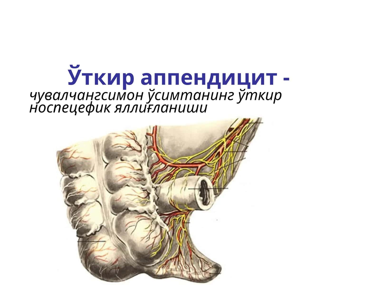 Ўткир аппендицит-чувалчангсимон ўсимтанинг ўткири носпецифик яллиғланиши