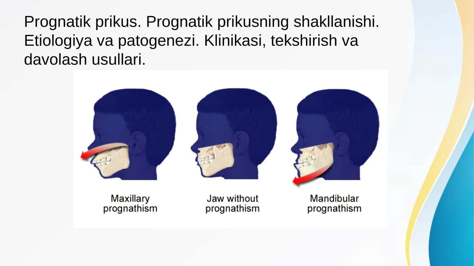 Prognatik prikus. Prognatik prikusning shakllanishi. Etiologiya va patogenezi. Klinikasi, tekshirish va davolash usullari.