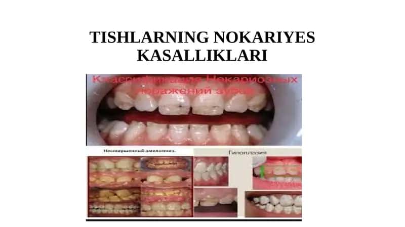 TISHLARNING NOKARIYES KASALLIKLARI