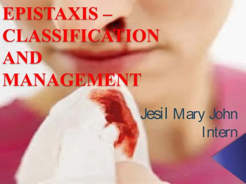 EPISTAXIS – CLASSIFICATION AND MANAGEMENT