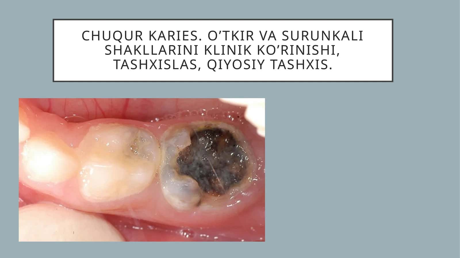 Chuqur karies