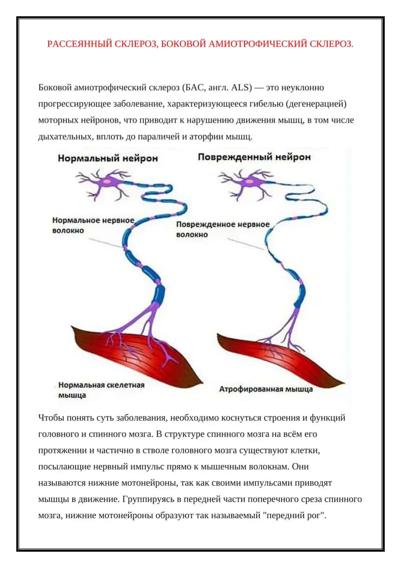Боковой амиотрофический склероз(БАС)