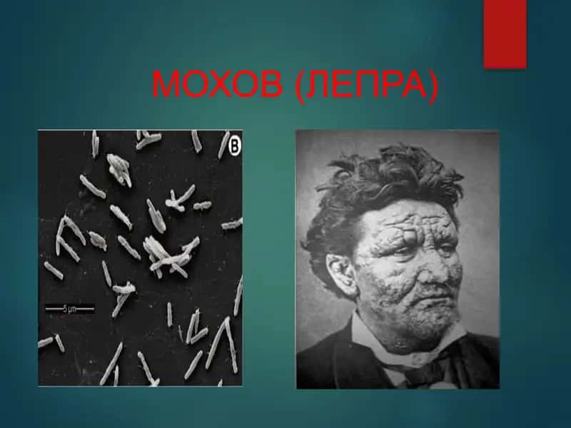 МОХОВ (ЛЕПРА)