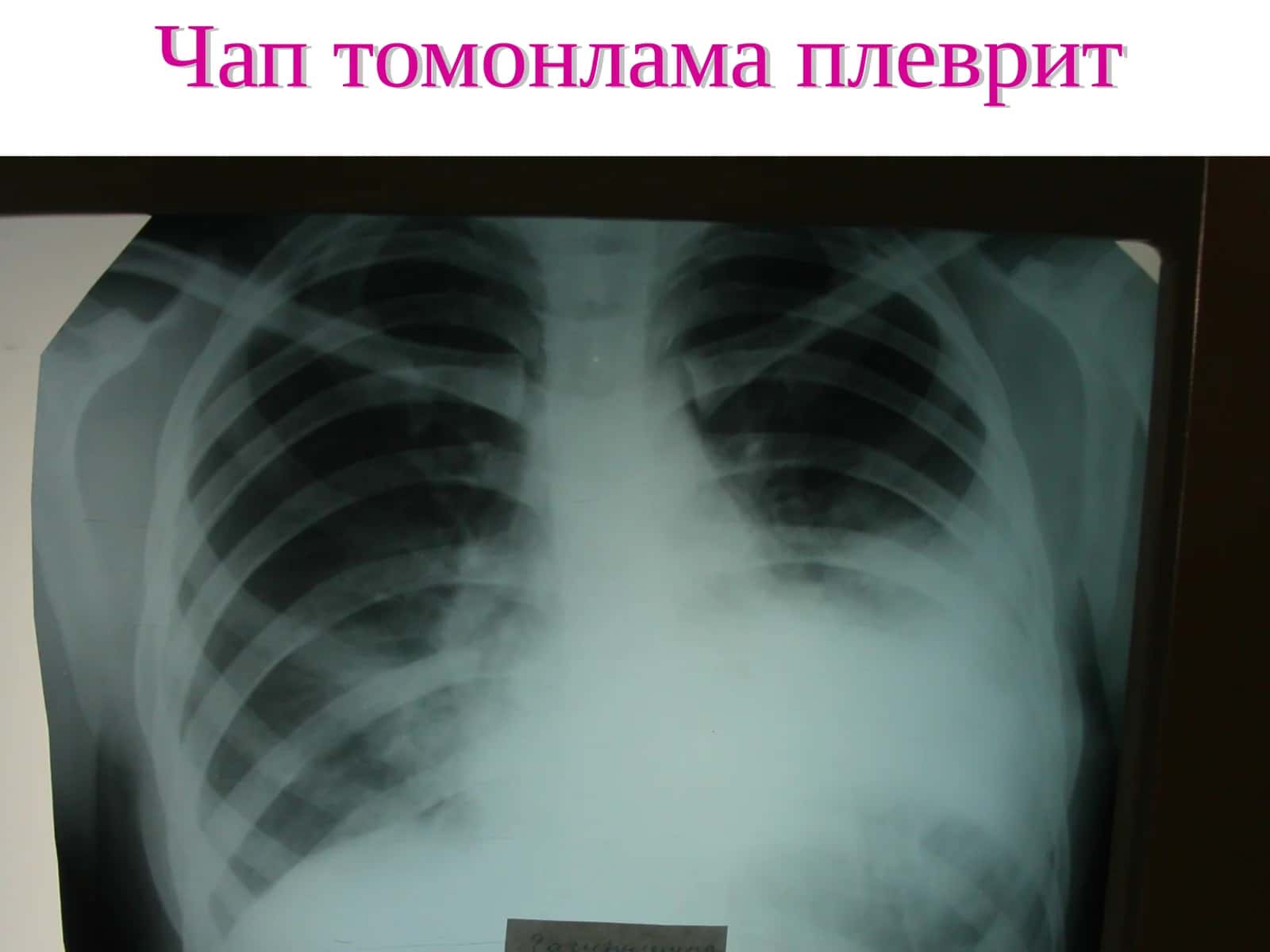 Чап томонлама плеврит
