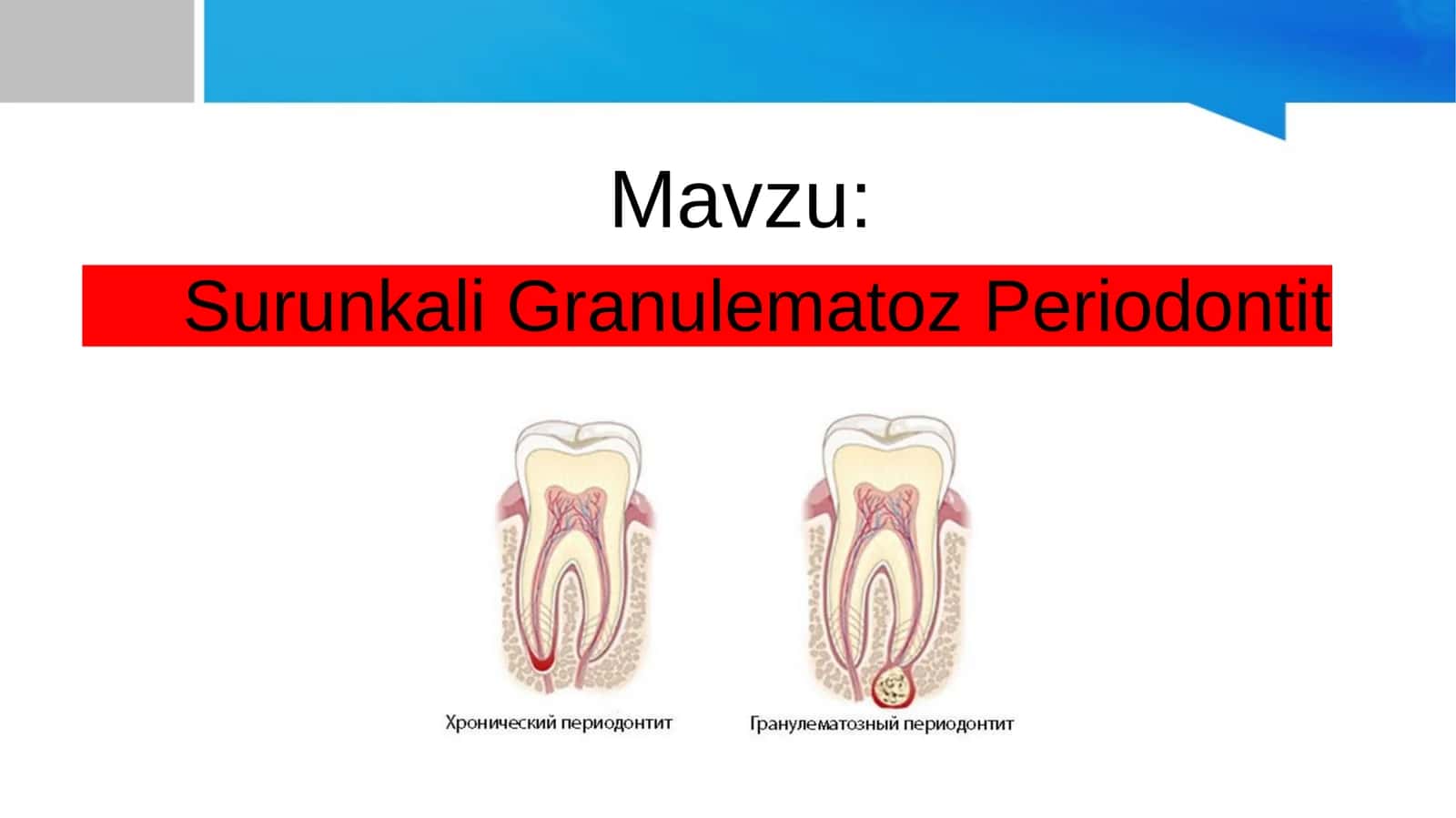 Surunkali granulematoz periodontit