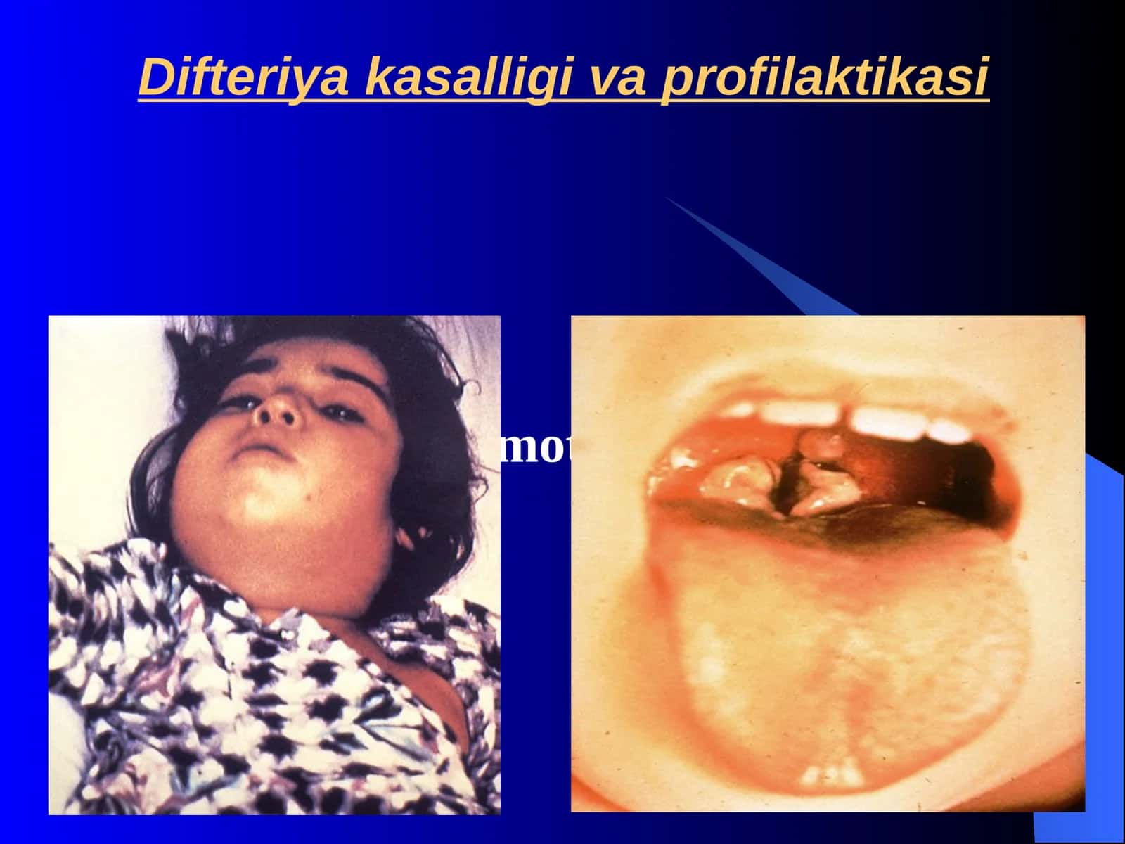 Difteriya kasalligi va profilaktikasi