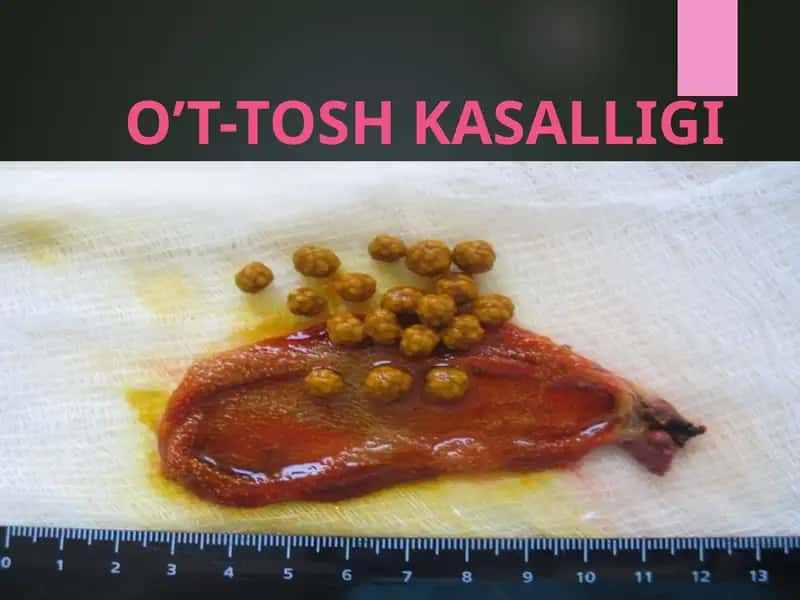 O’T-TOSH KASALLIGI