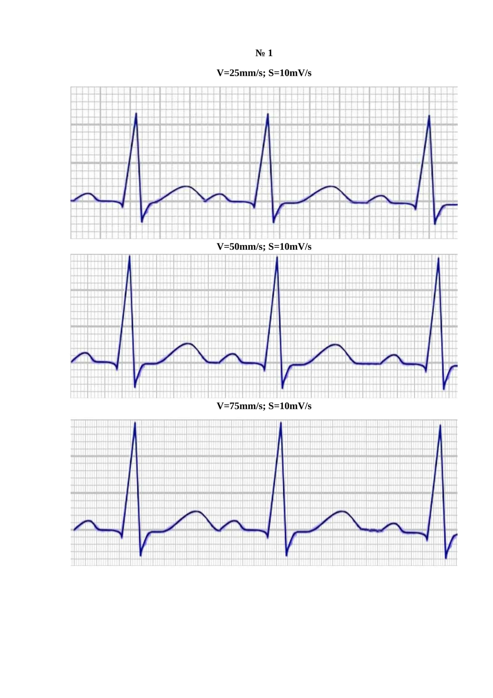 V=25mm/s; S=10mV/s