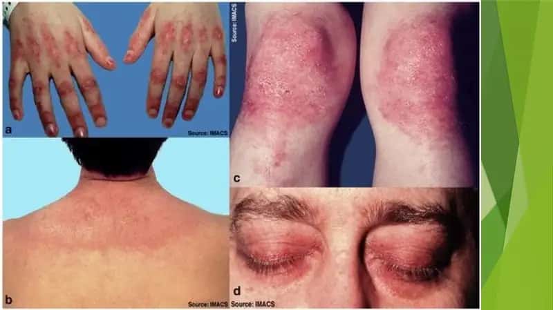 DERMATOMIOZIT