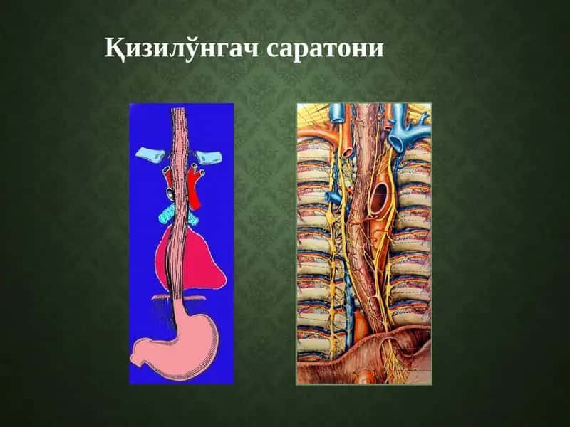 Қизилўнгач саратони