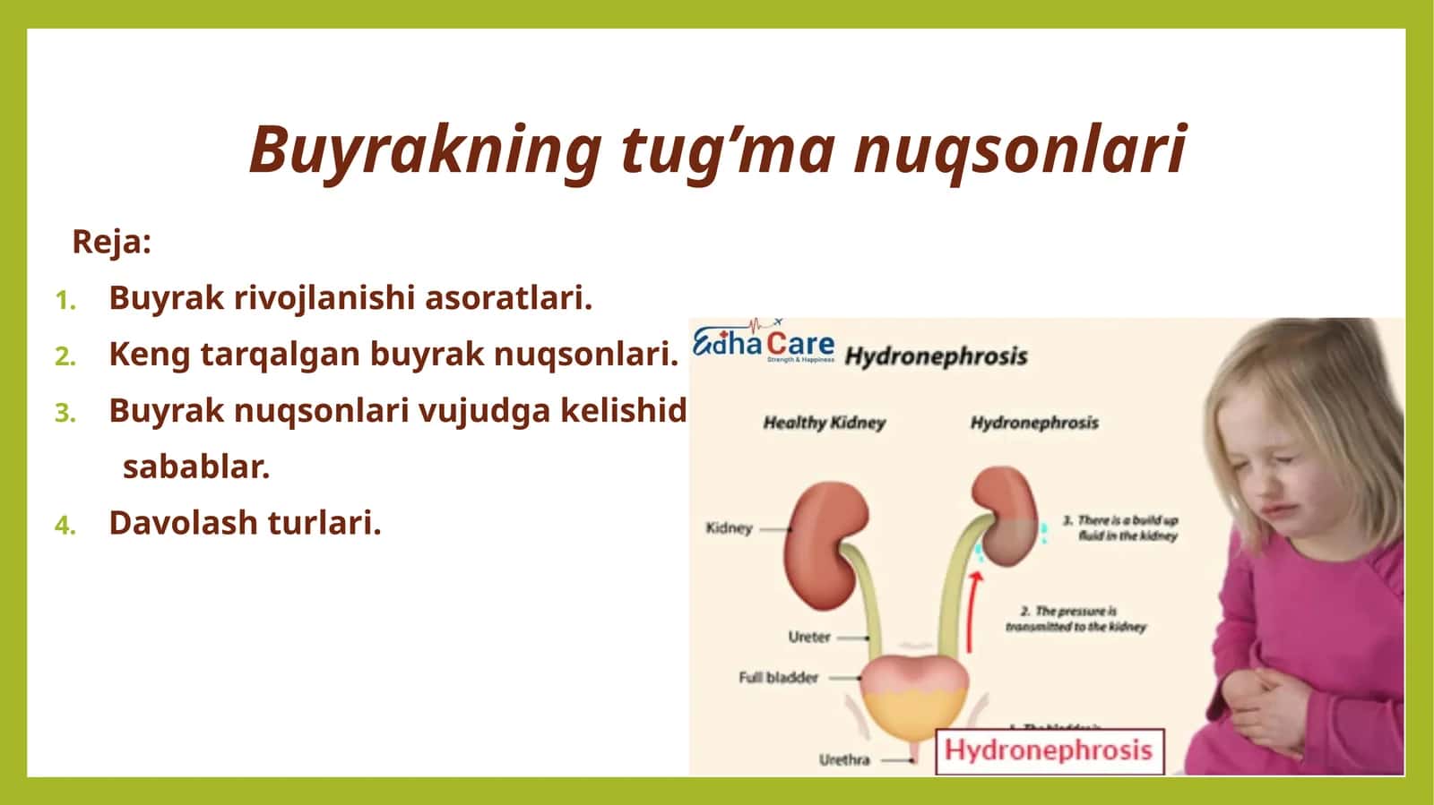 Buyrakning tug’ma nuqsonlari