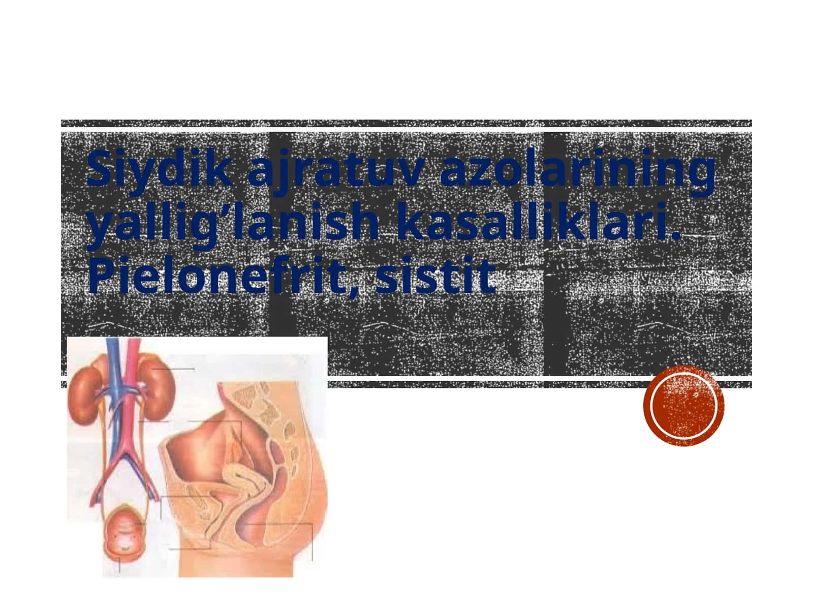 Siydik yo’llari yallig’lanish kasalliklari. Pielonefrit, sistit