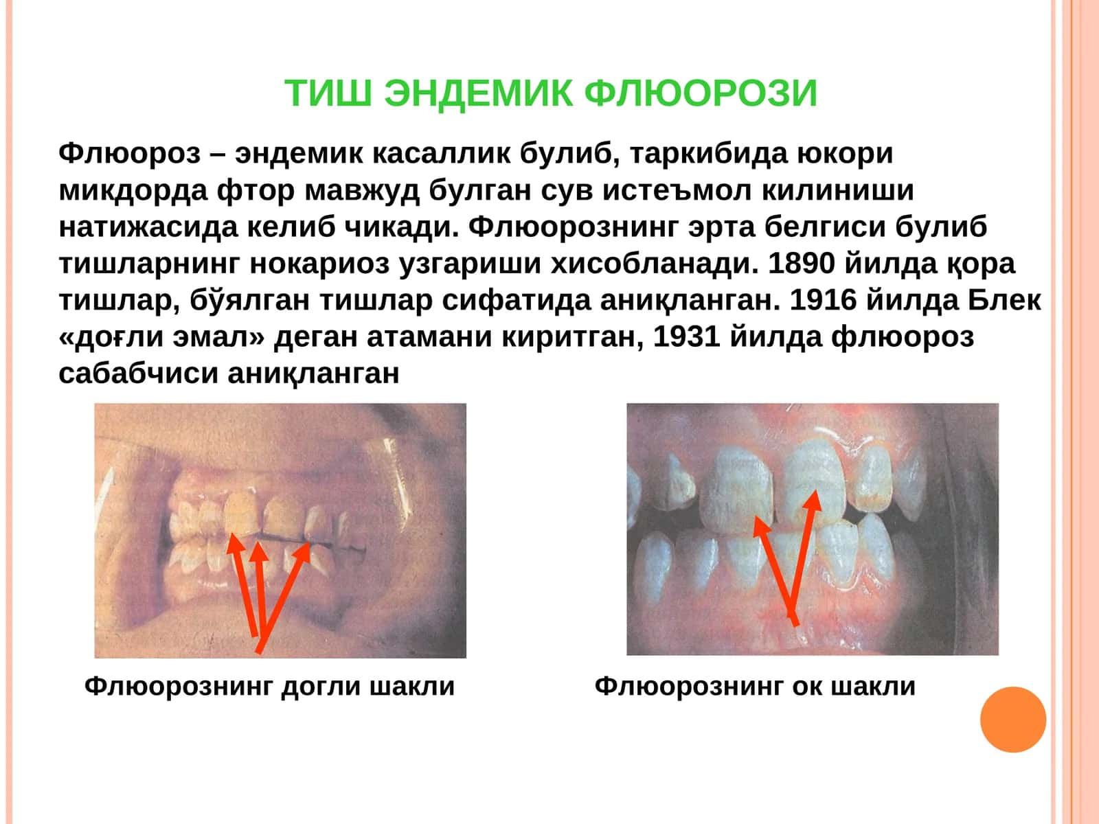 Тиш эндемик флюорози