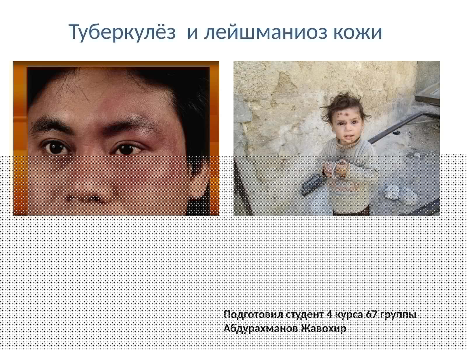 Туберкулёз и лейшманиоз кожи