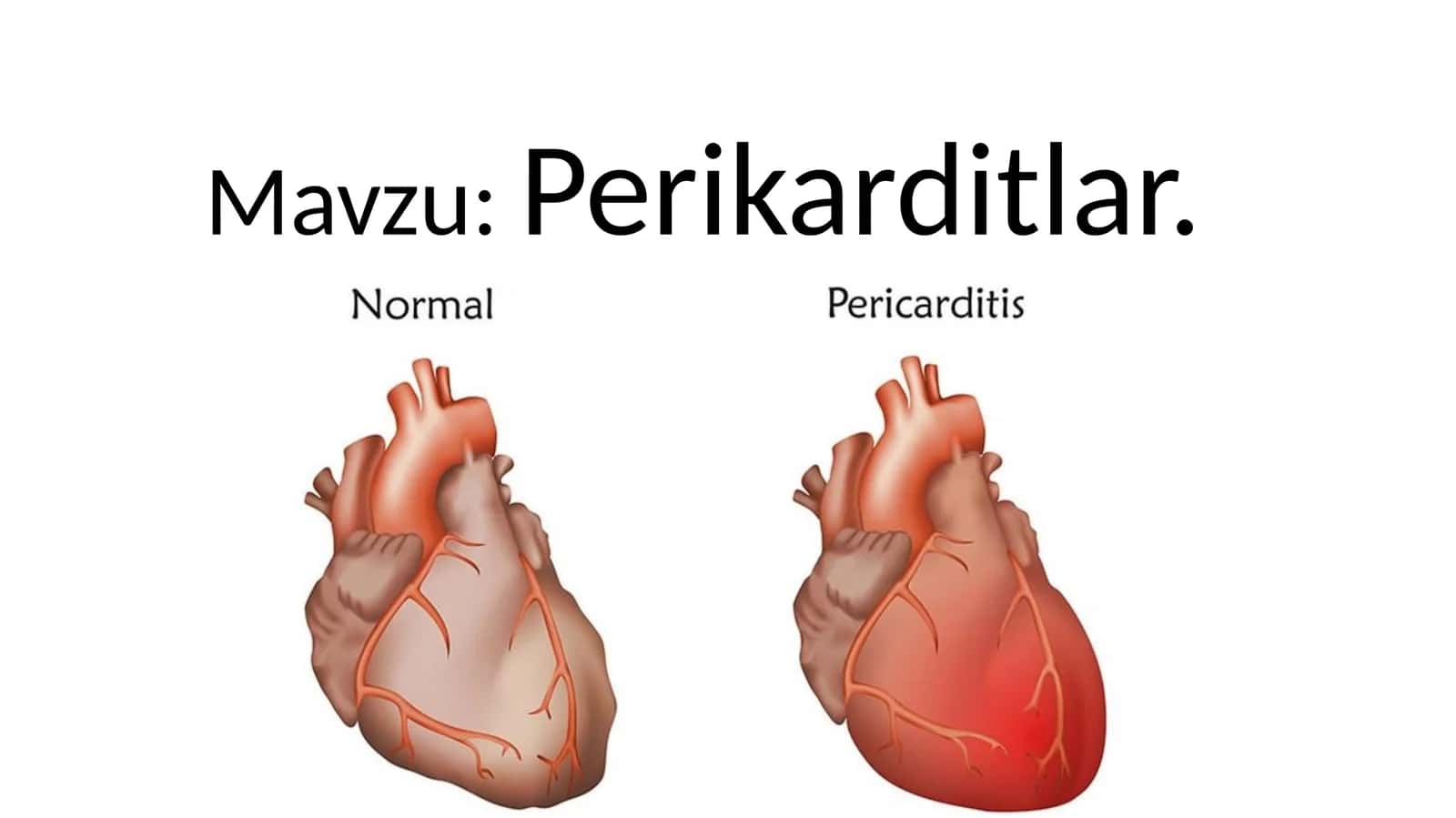 Perikarditlar