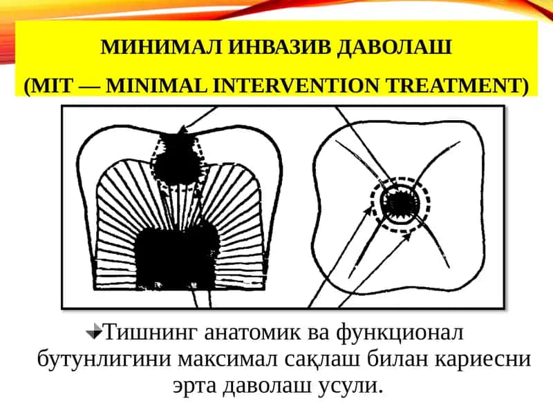 МИНИМАЛ ИНВАЗИВ ДАВОЛАШ (MIT — minimal intervention treatment)