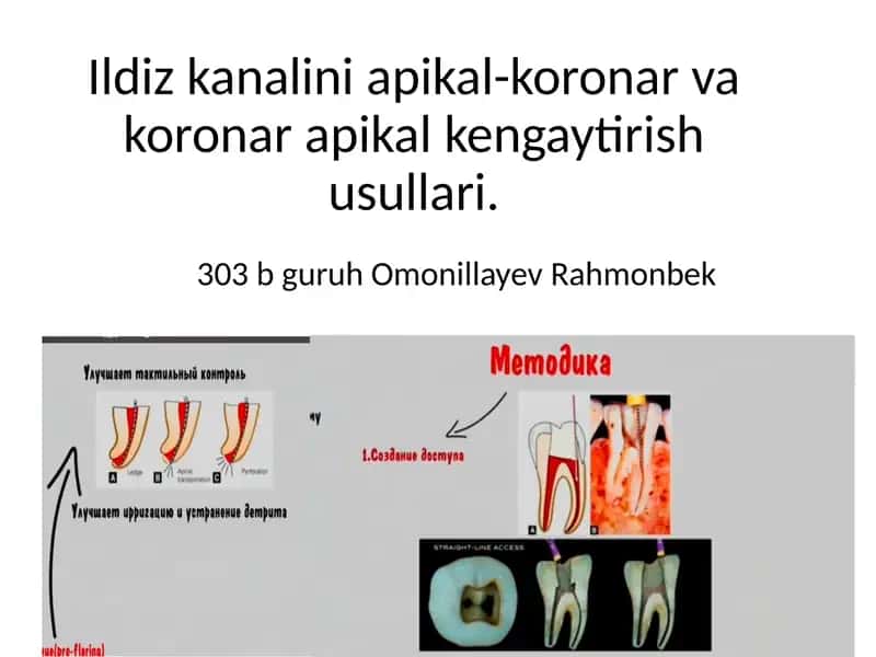 Ildiz kanalini apikal-koronar va koronar apikal kengaytirish usullari.