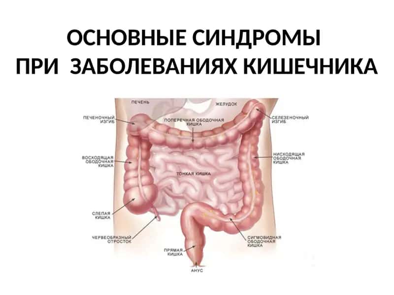 ОСНОВНЫЕ СИНДРОМЫ ПРИ  ЗАБОЛЕВАНИЯХ КИШЕЧНИКА