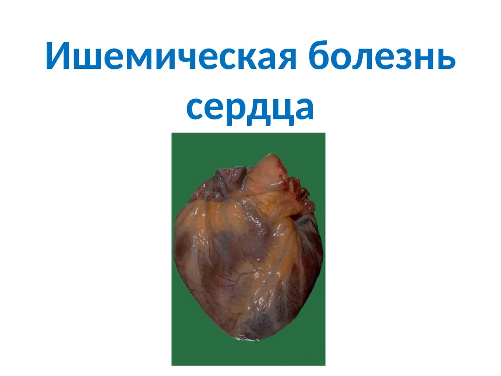 Ишемическая болезнь сердца
