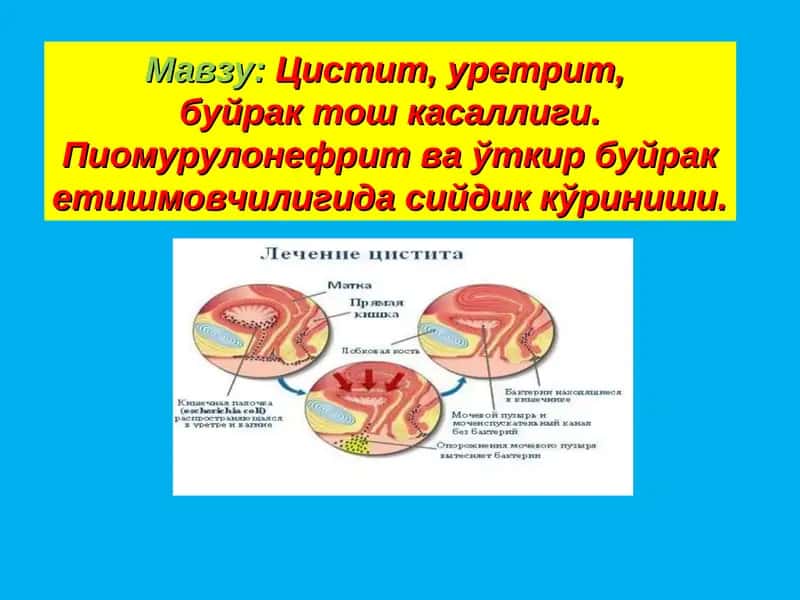 Цистит, уретрит, буйрак тош касаллиги