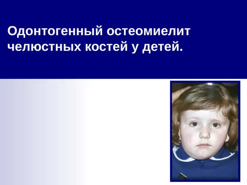 Одонтогенный остеомиелит челюстных костей у детей