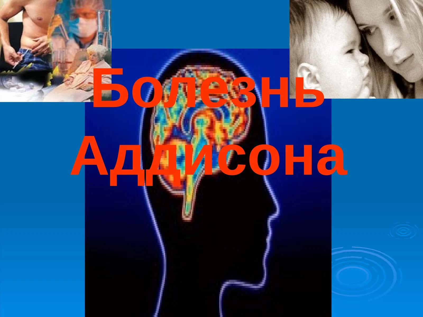 Болезнь Аддисона