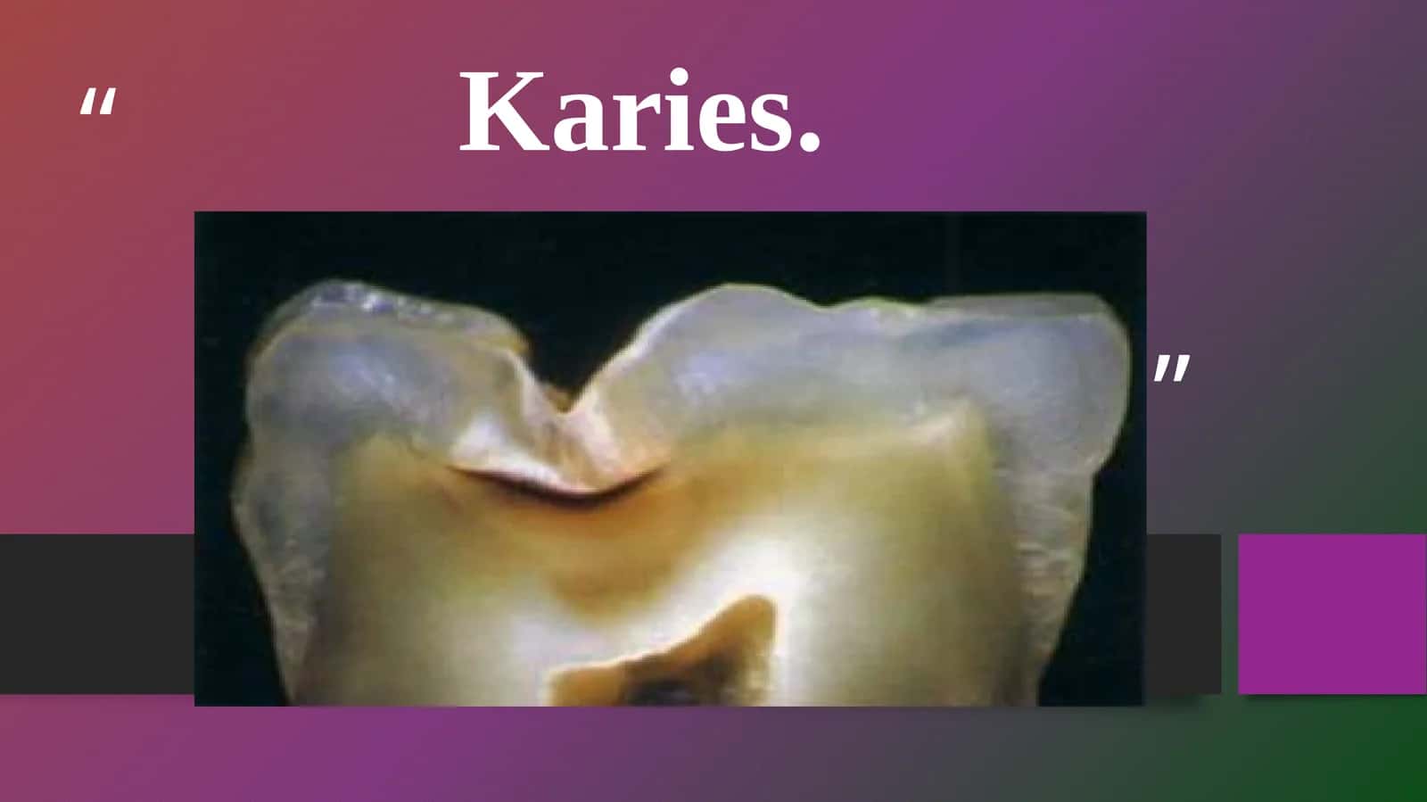 Karies