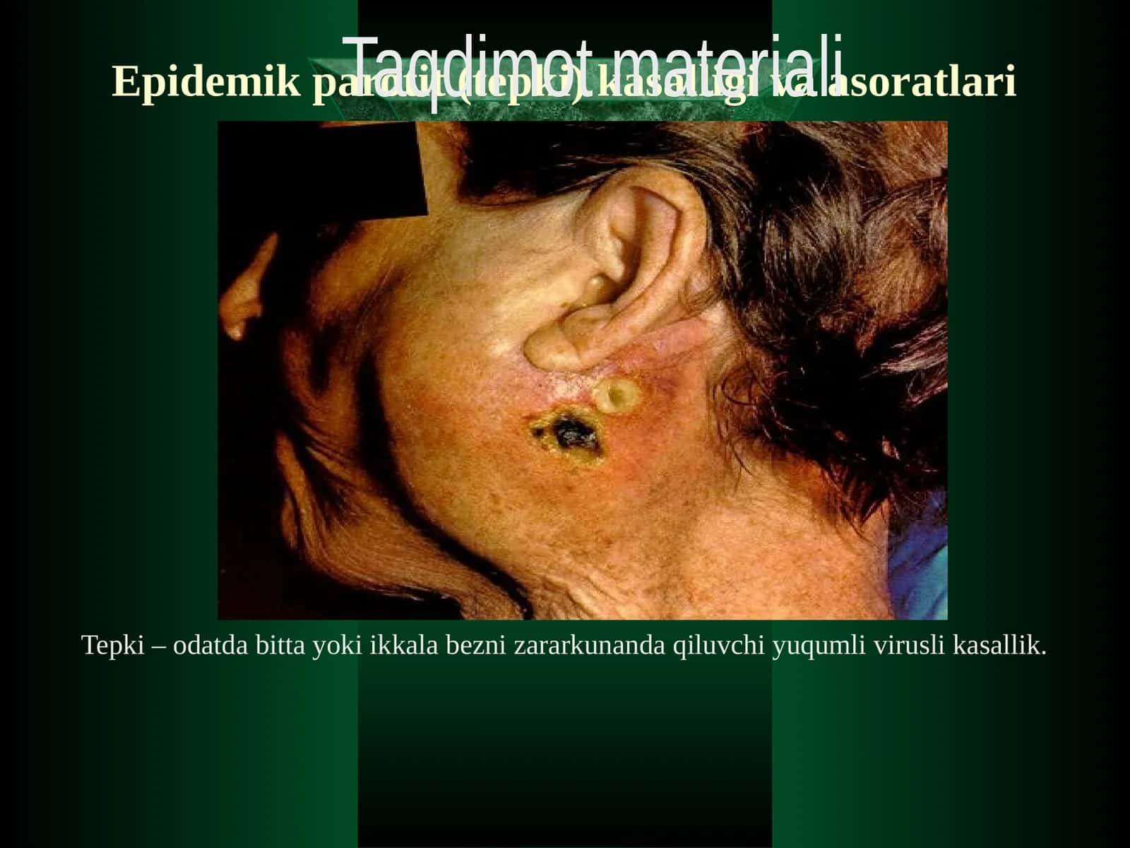 Epidemik parotit (tepki) kasalligi va asoratlari