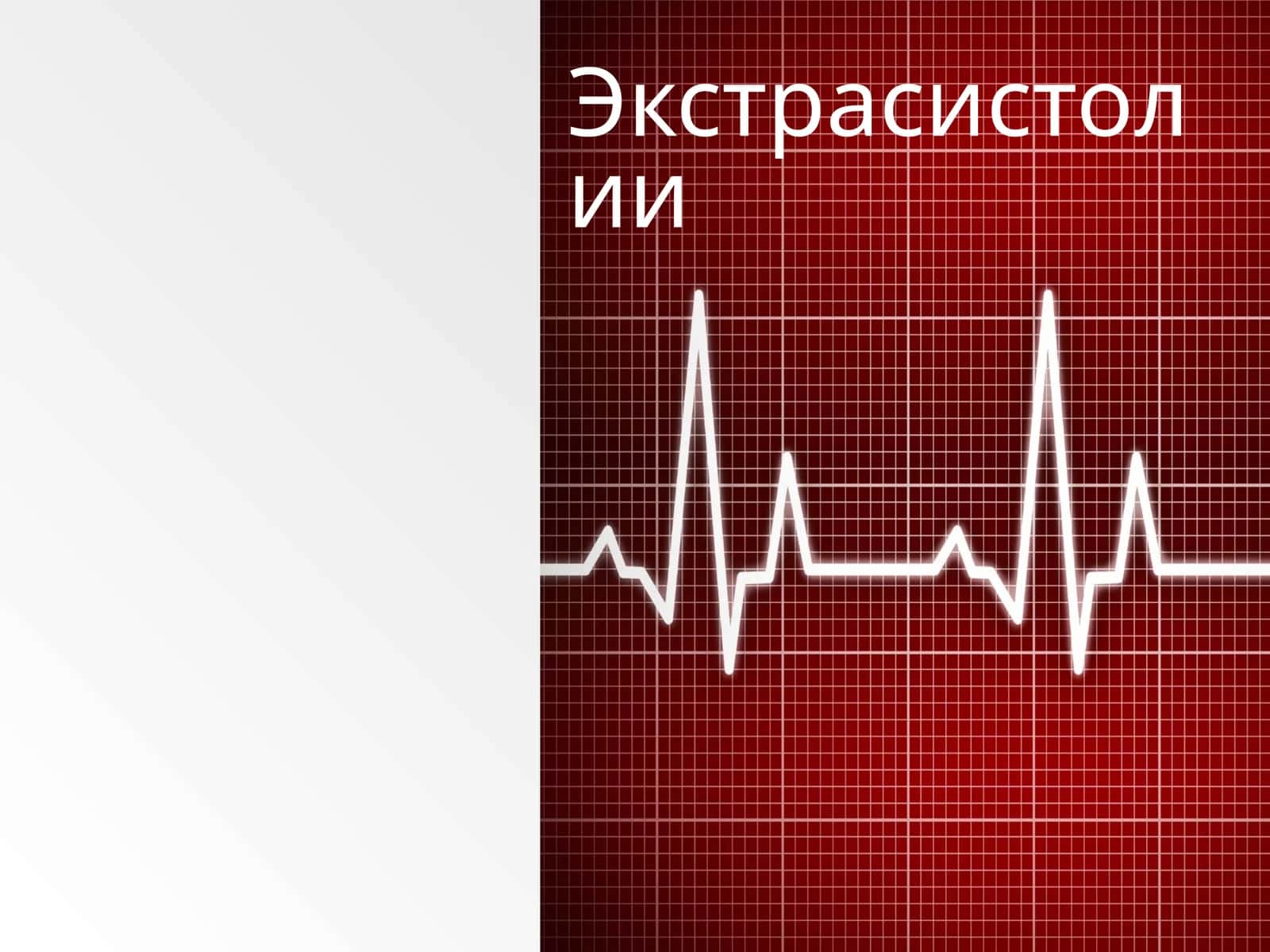 Экстрасистолии