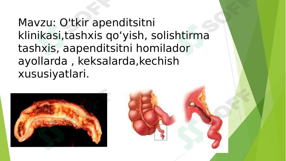 Oʻtkir apendisitni klinikasi